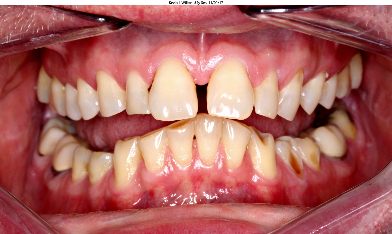 gap between upper lower teeth